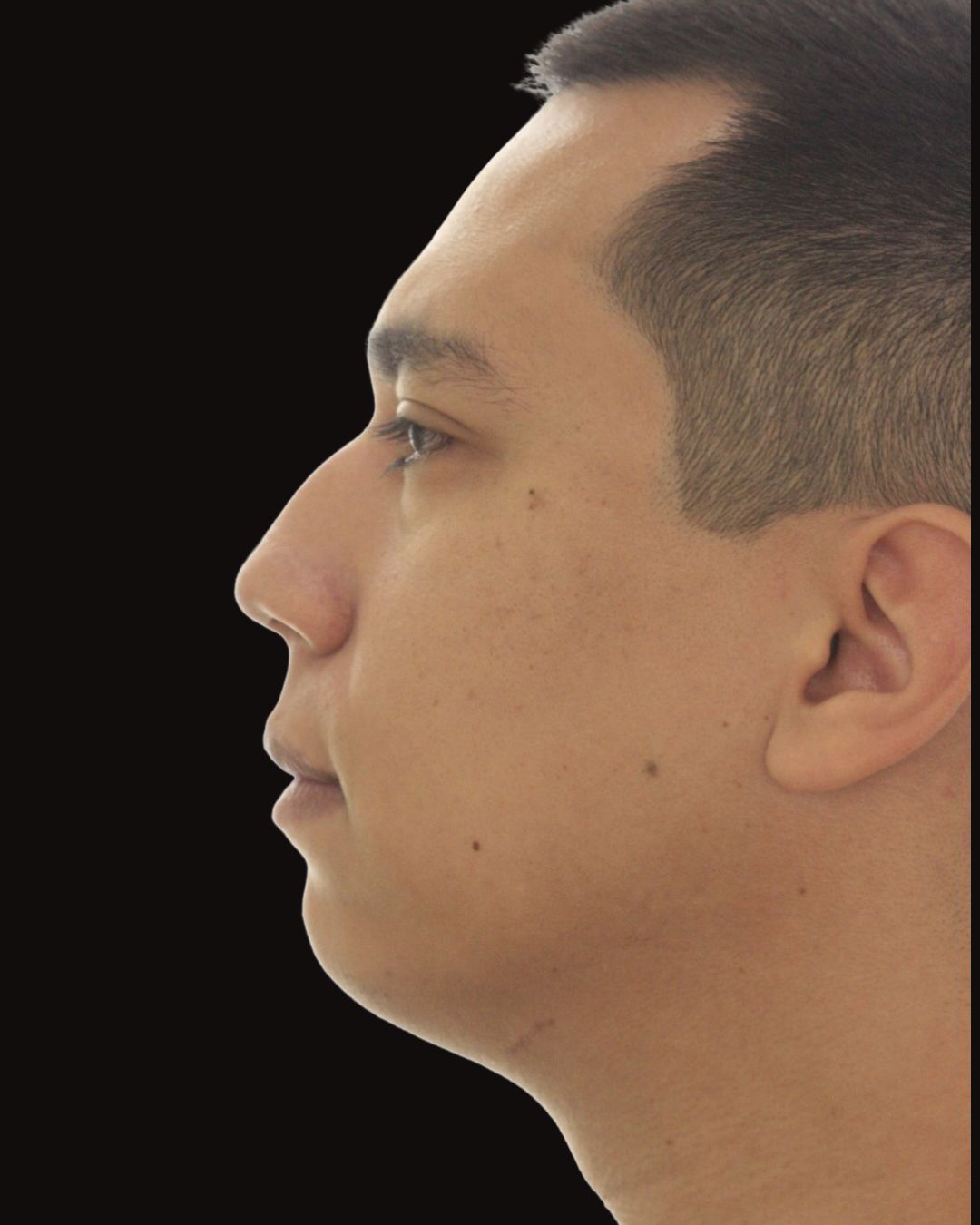 Antes - Mentoplastia