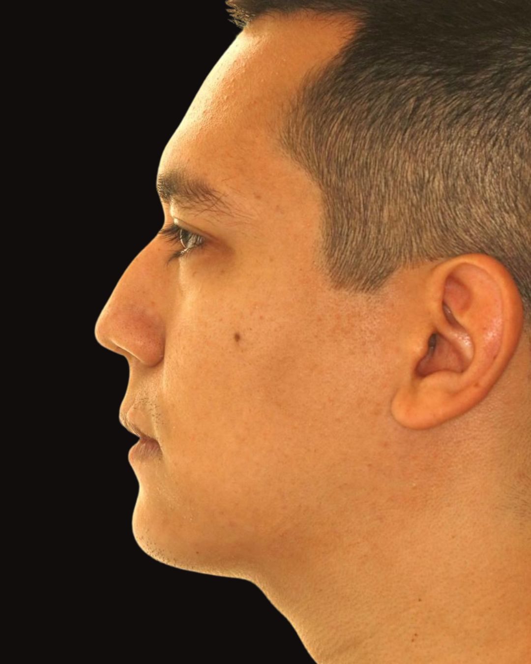 Depois - Mentoplastia