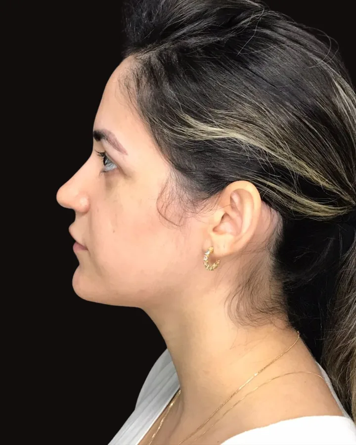 Resultado de cirurgia ortognática